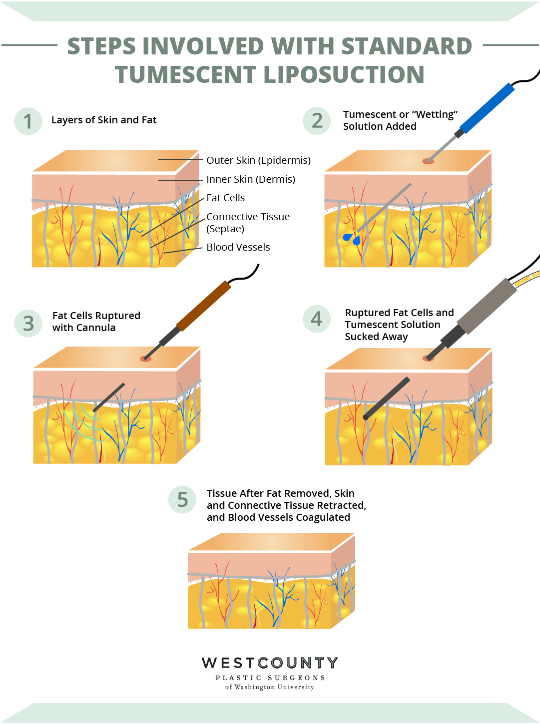 See how tumescent liposuction works at St. Louis’ West County Plastic Surgeons.
