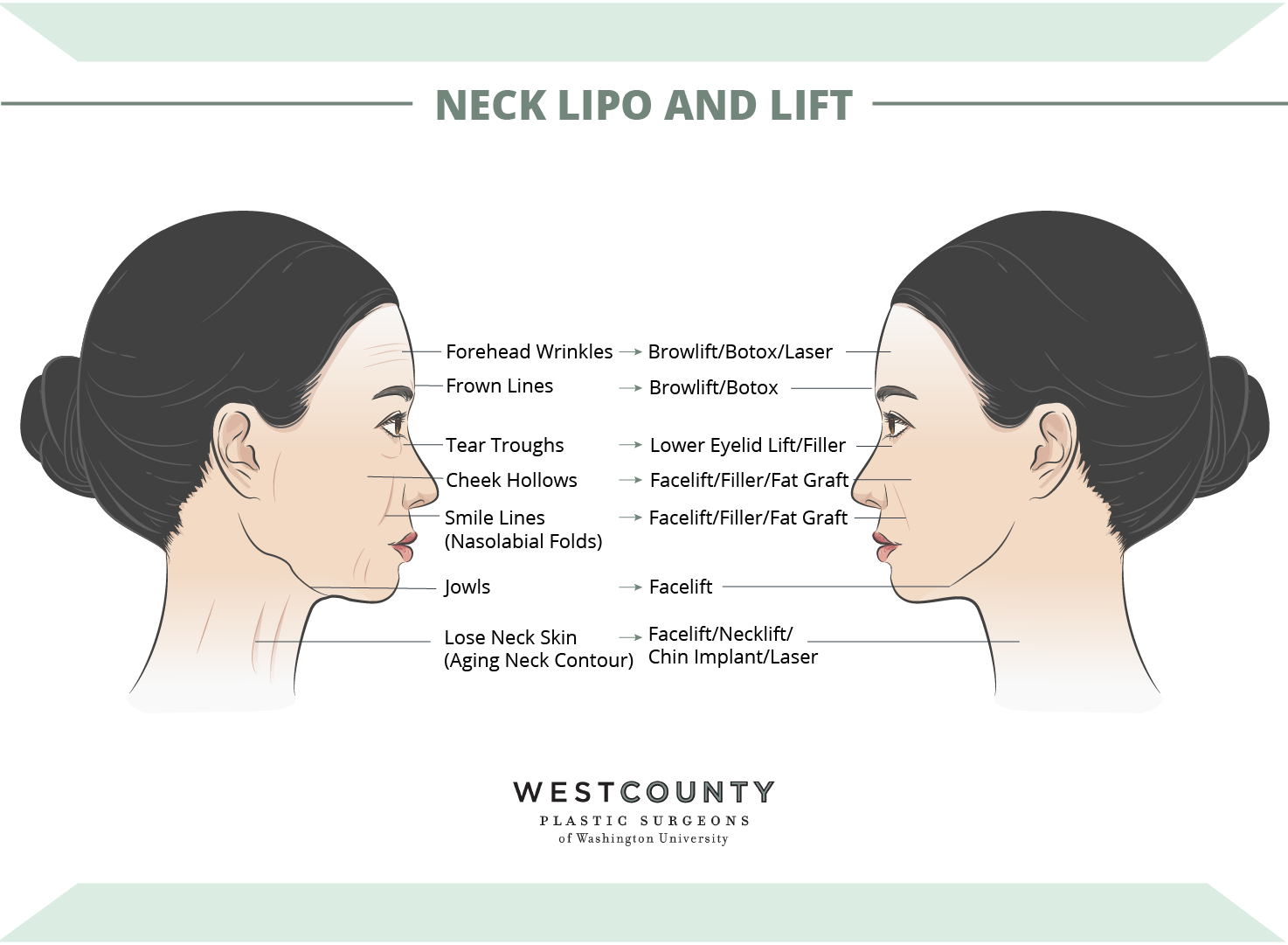 Comprehensive facial rejuvenation surgery can include neck lipo and lift at St. Louis’ West County Plastic Surgeons