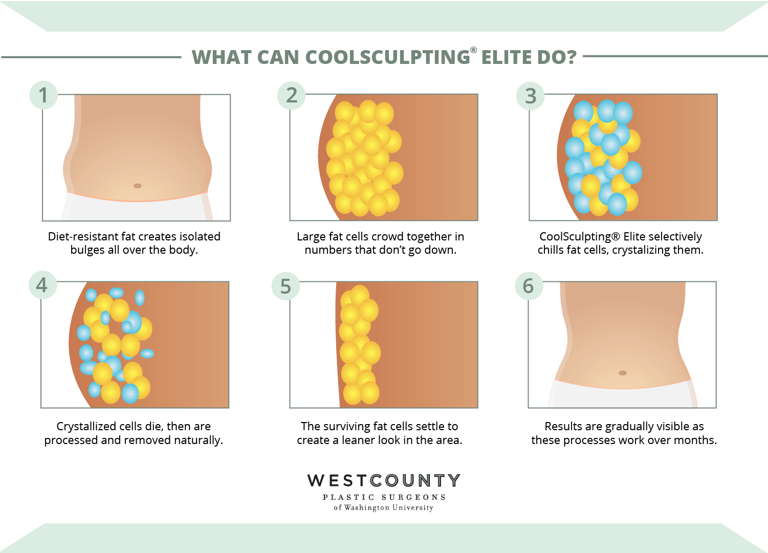 Discover CoolSculpting® Elite at St. Louis’ West County Plastic Surgeons.