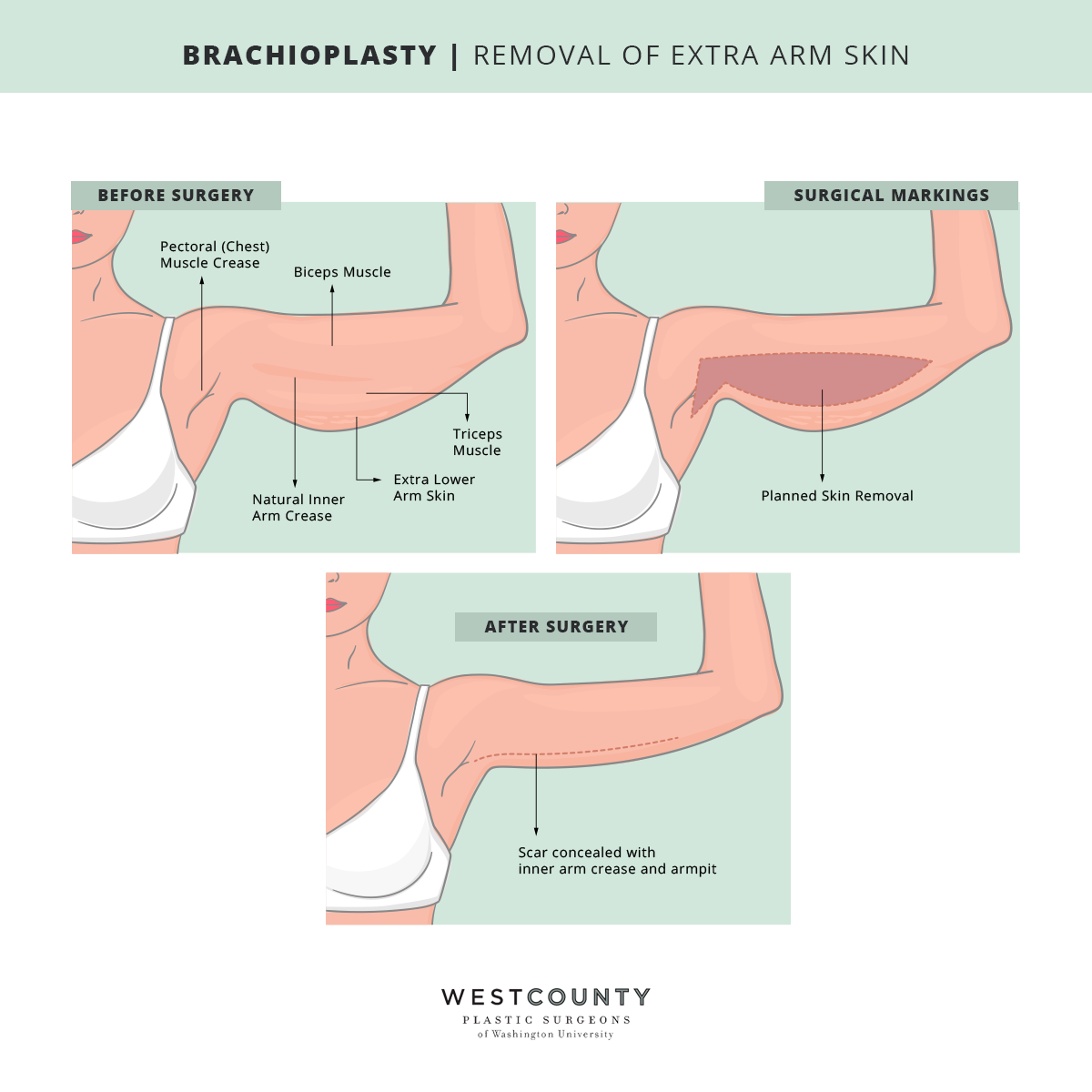 The West County Plastic Surgeons team customizes each arm lift in St. Louis to take muscles, creases, and other contours into account for a natural-looking result.