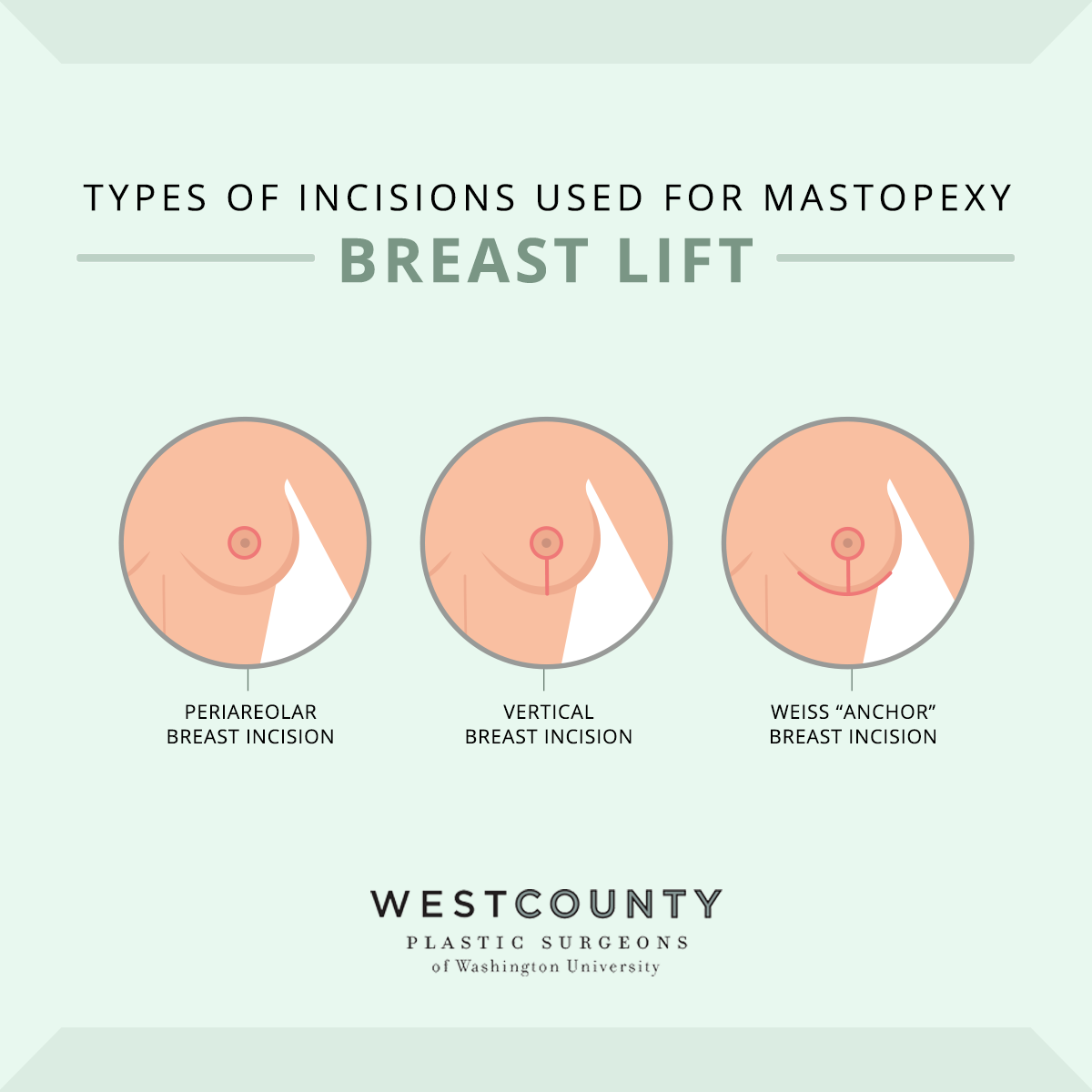 See the three incisions used for breast lift surgery (mastopexy) at West County Plastic Surgeons in St. Louis.