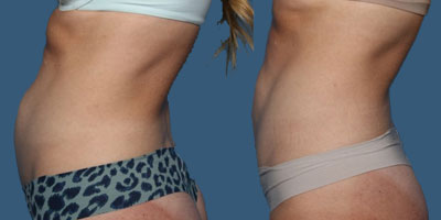 Before-and-after photos of a patient who choose CoolTone™ at St. Louis, West County Plastic Surgeons.