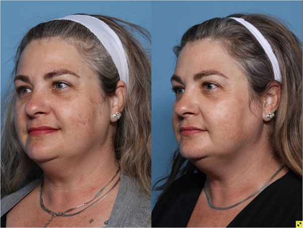 IPL Sideview Before and After