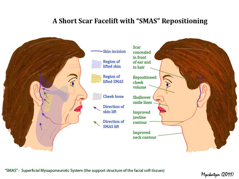 short-scar-facelift