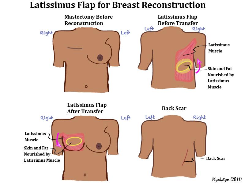 LatIssimus-Flap