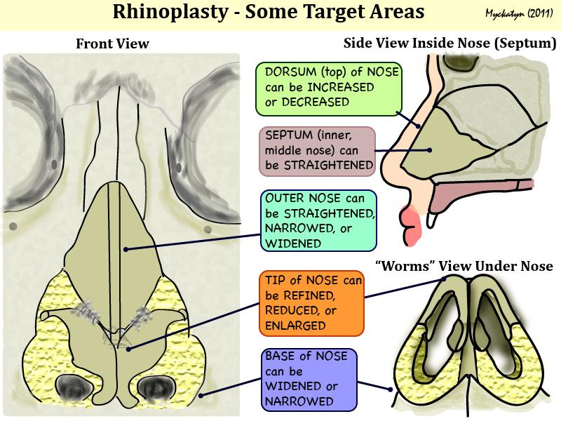 RHINOPLASTY