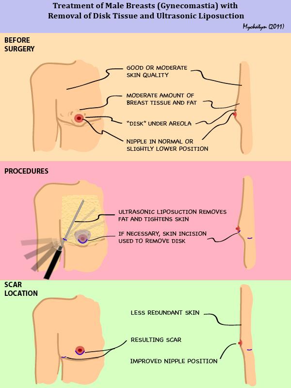 Treatment Options for Gyn