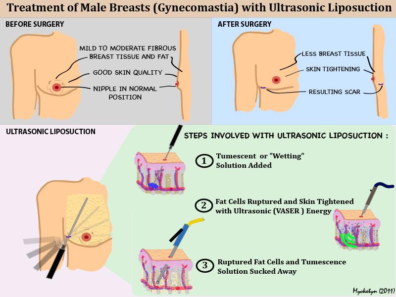 Ultrasonic Liposuction