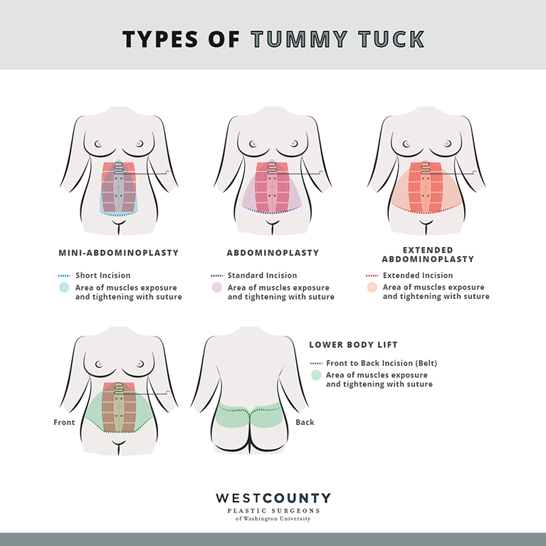 Choose from several methods of tummy tuck surgery at West County Plastic Surgeons in St. Louis.