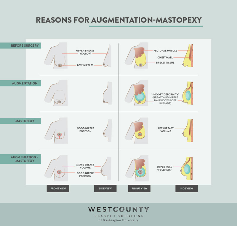 An augmentation-mastopexy adds volume while lifting sagging tissue to create a fuller, more elevated breast for patients at West County Plastic Surgeons in St. Louis.